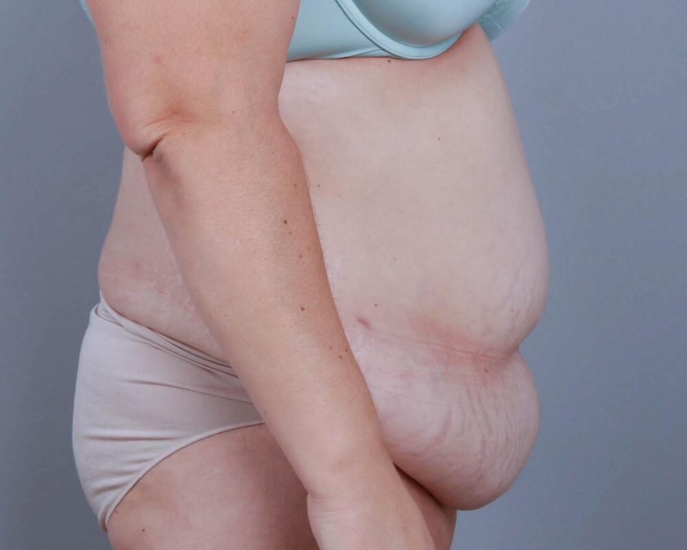 Tummy Tuck Before & After Image