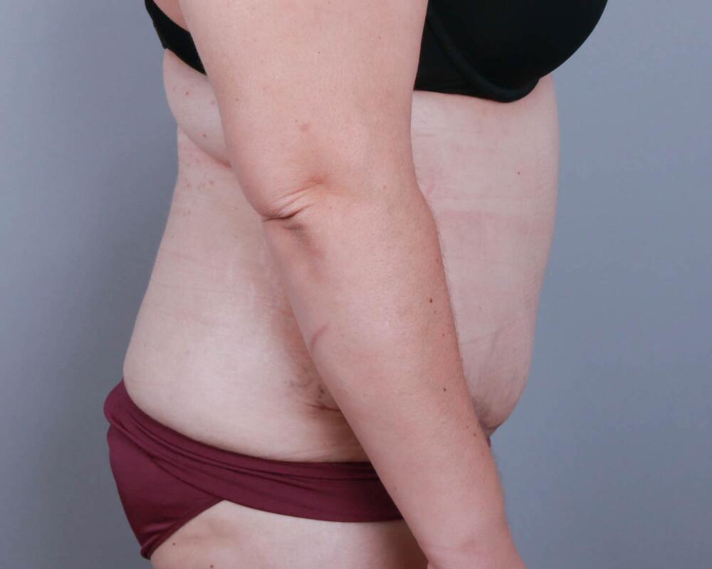 Tummy Tuck Before & After Image