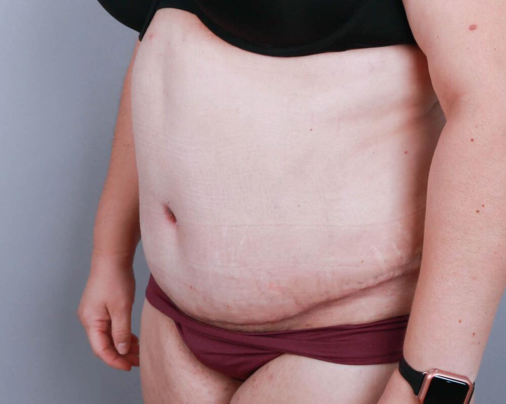 Tummy Tuck Before & After Image