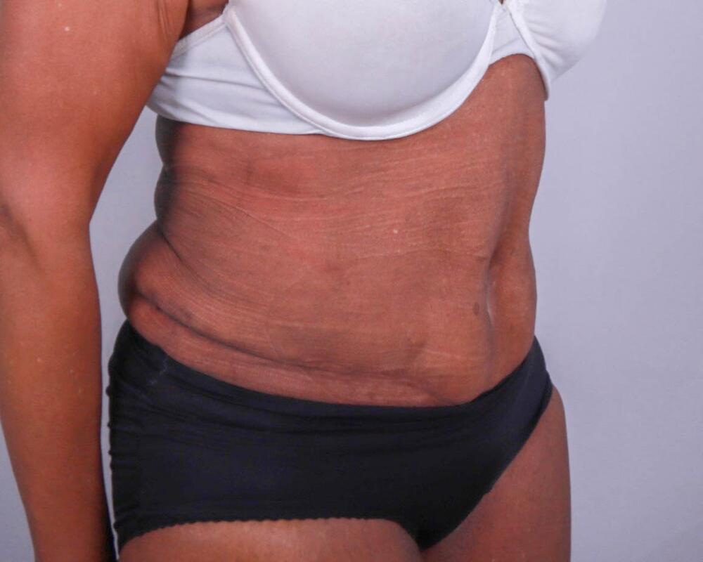 Tummy Tuck Before & After Image