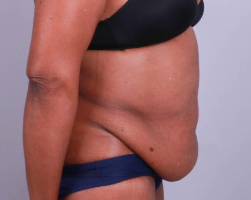 Tummy Tuck Before & After Image