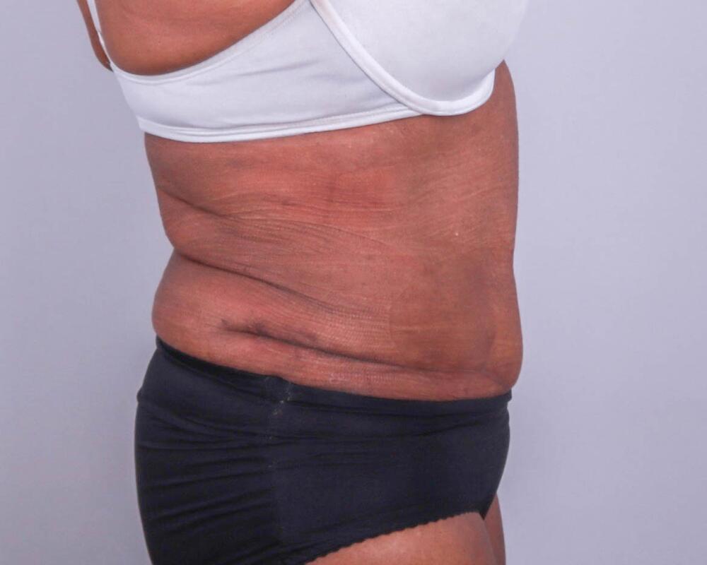 Tummy Tuck Before & After Image