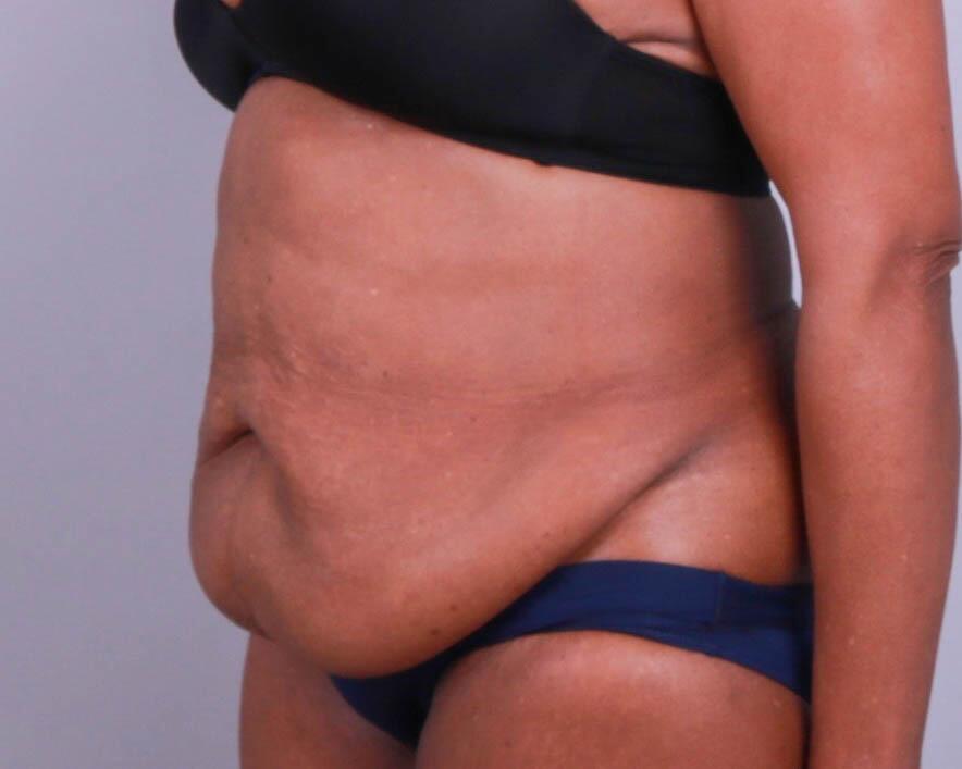 Tummy Tuck Before & After Image