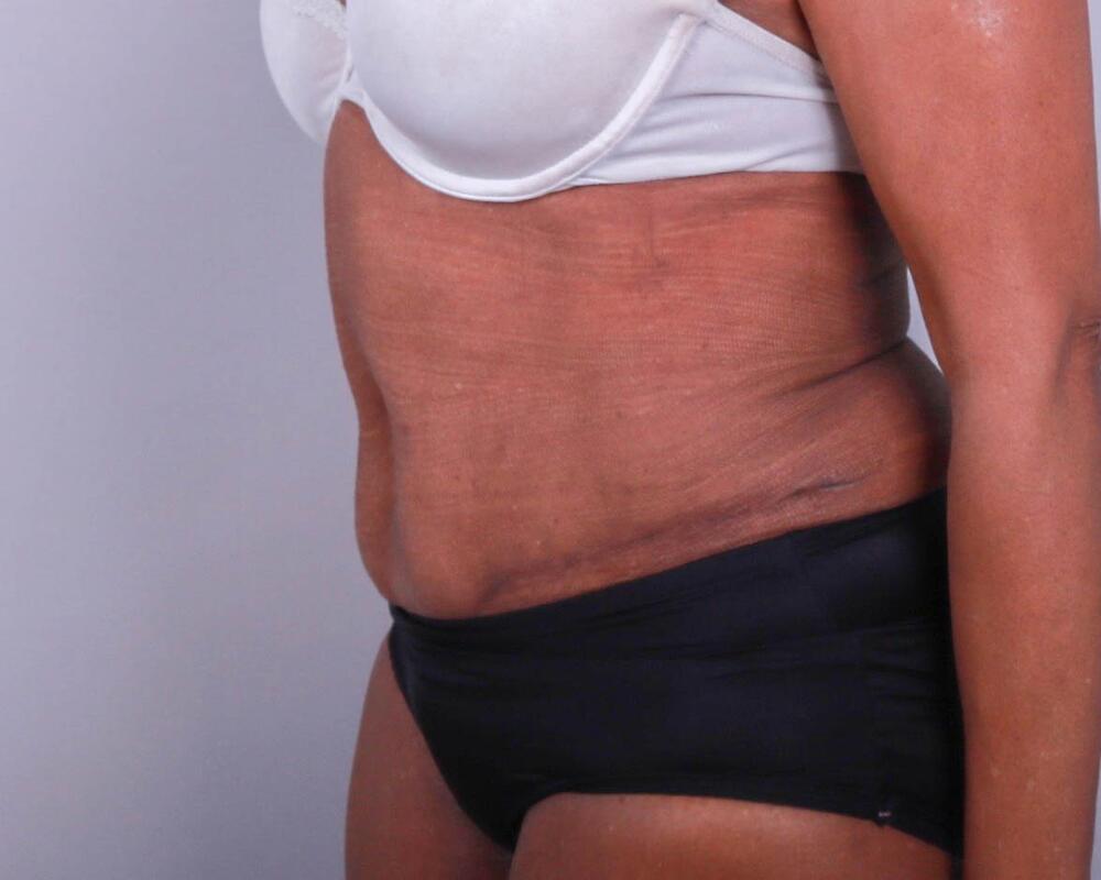 Tummy Tuck Before & After Image