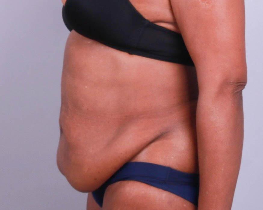 Tummy Tuck Before & After Image