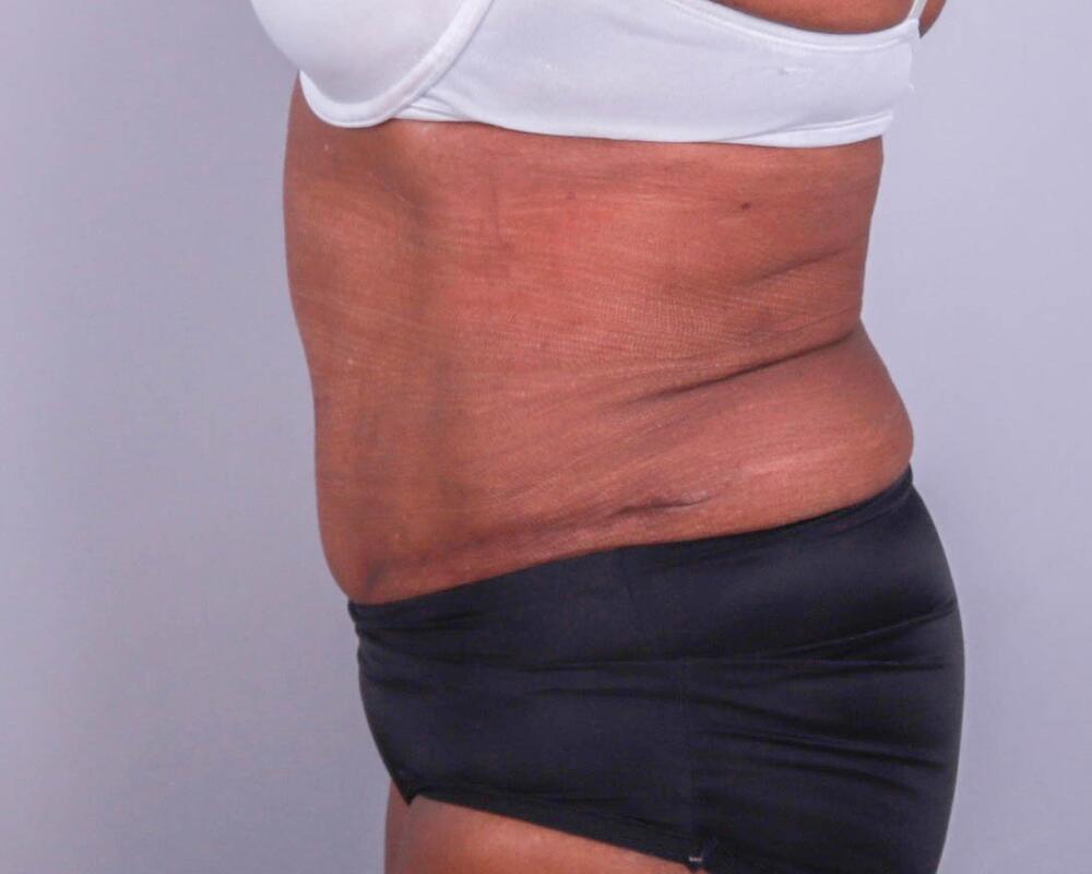 Tummy Tuck Before & After Image