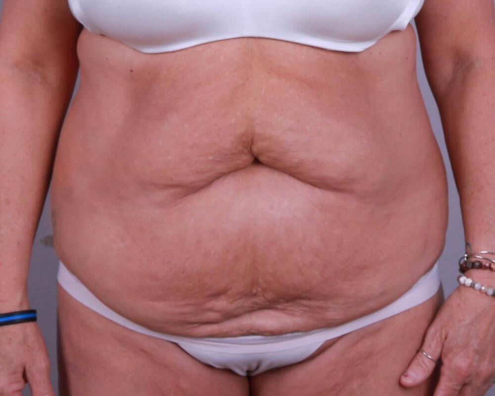 Tummy Tuck Before & After Image