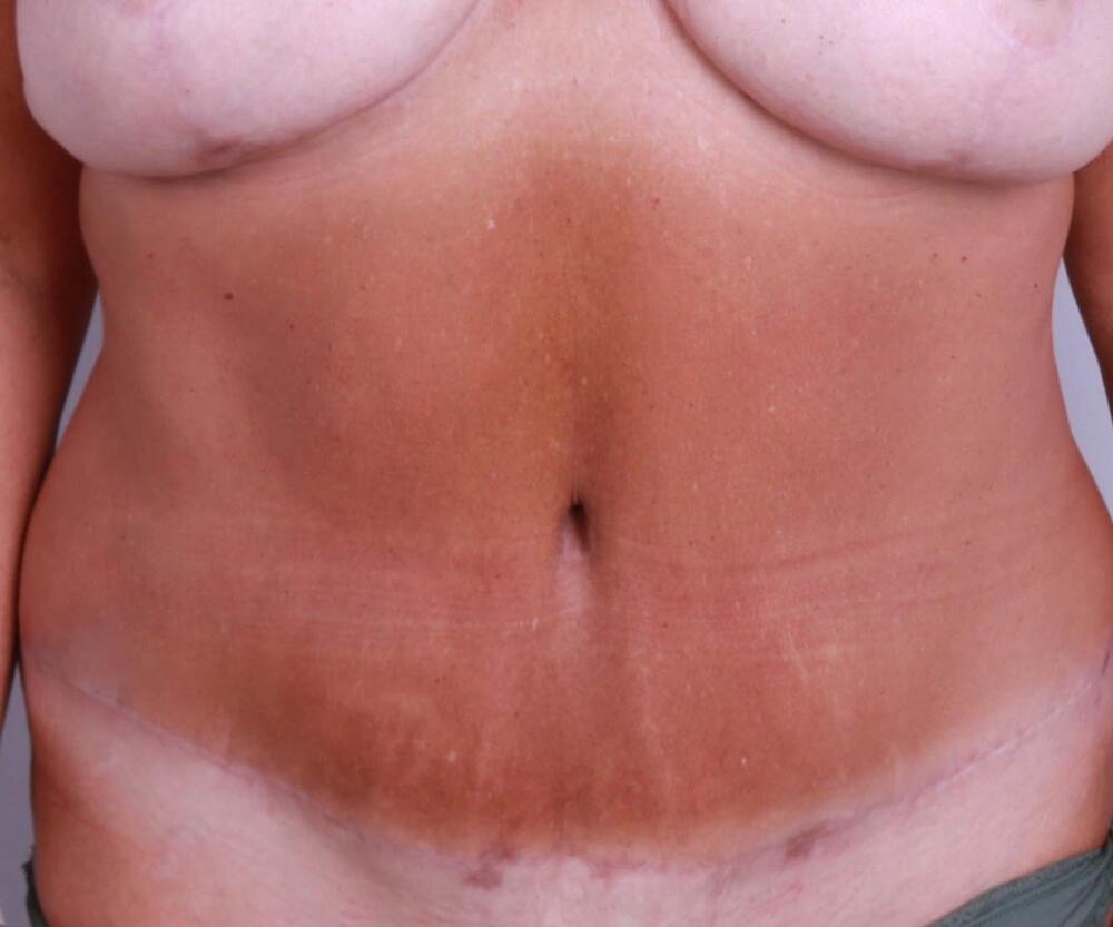 Tummy Tuck Before & After Image