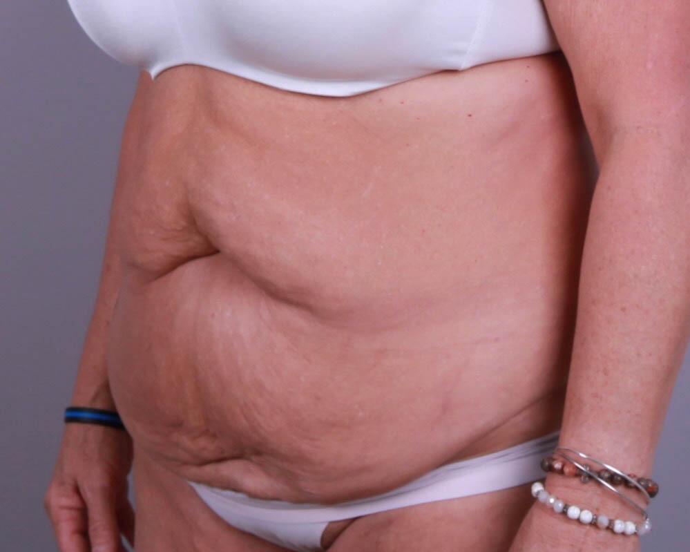 Tummy Tuck Before & After Image