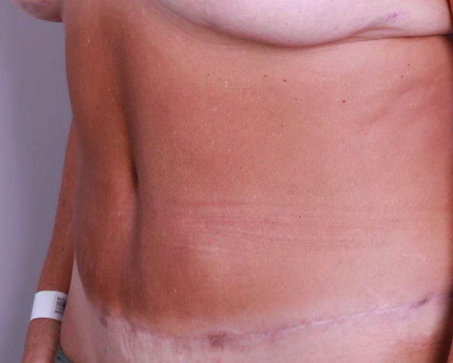 Tummy Tuck Before & After Image