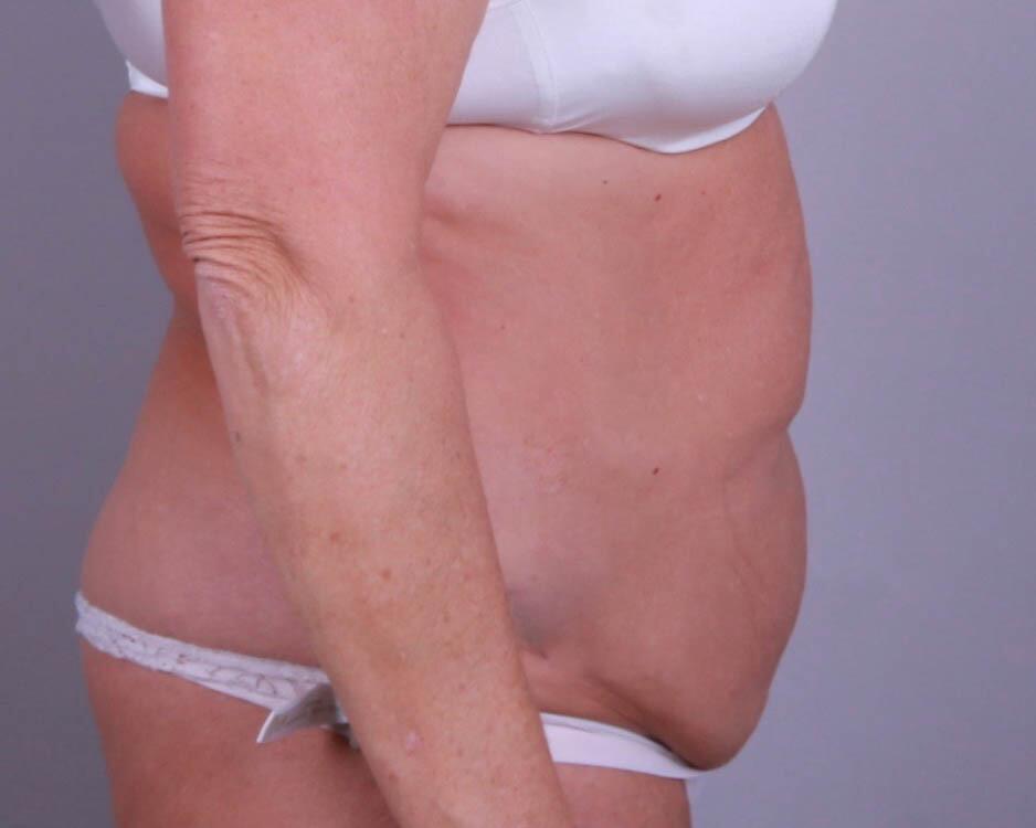 Tummy Tuck Before & After Image