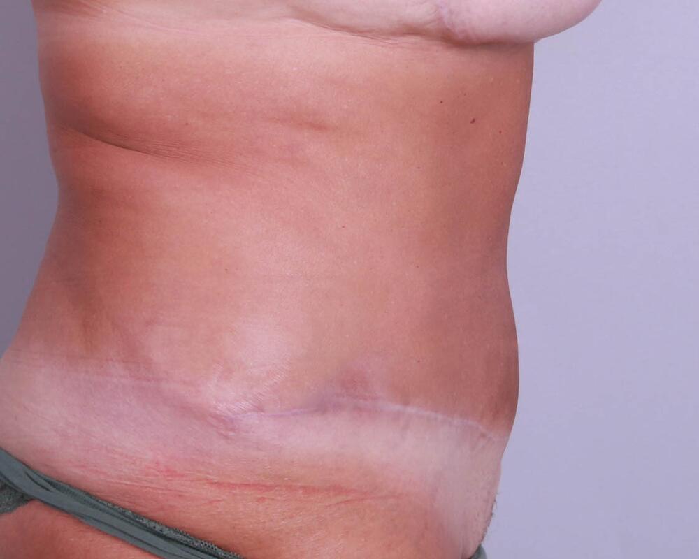 Tummy Tuck Before & After Image