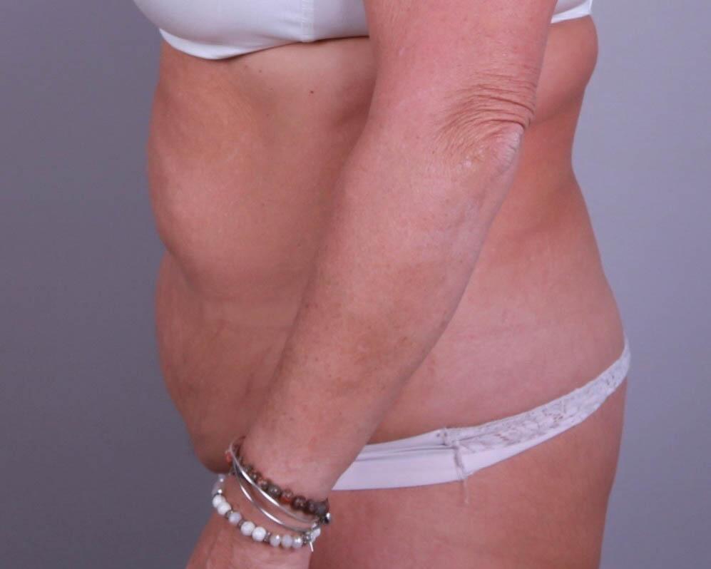 Tummy Tuck Before & After Image