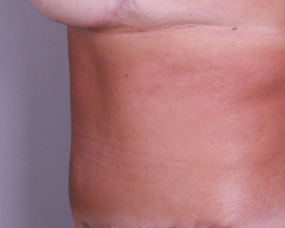 Tummy Tuck Before & After Image