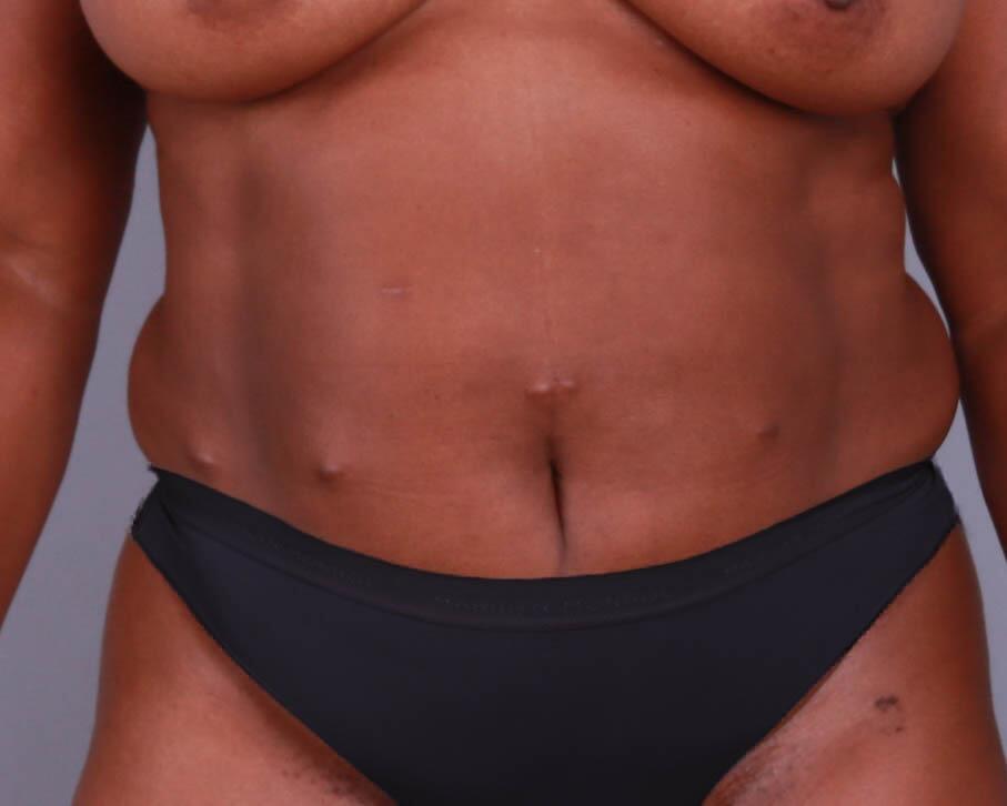 Tummy Tuck Before & After Image