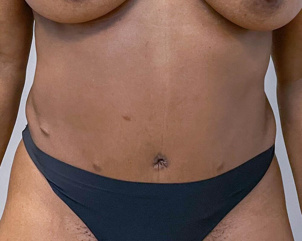 Tummy Tuck Before & After Image