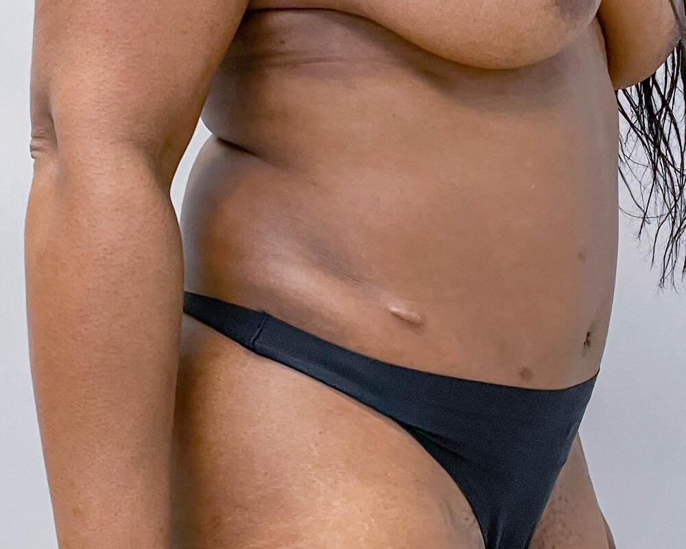 Tummy Tuck Before & After Image