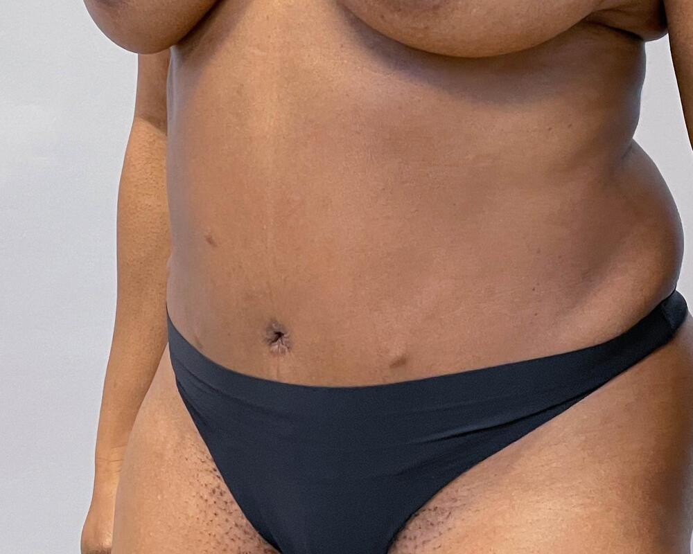 Tummy Tuck Before & After Image