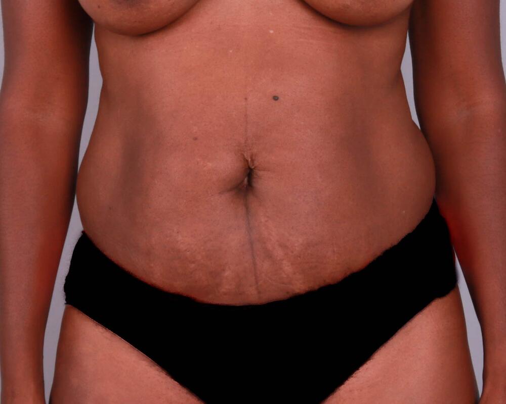 Tummy Tuck Before & After Image