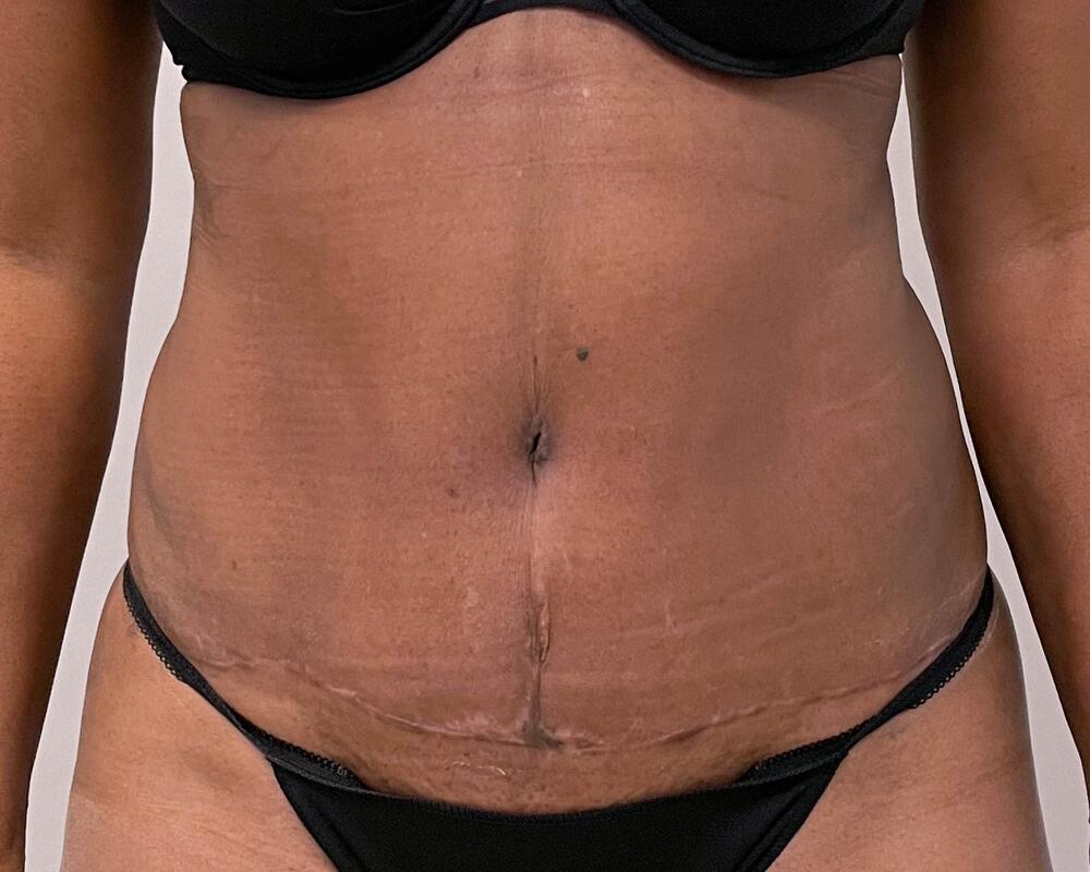 Tummy Tuck Before & After Image