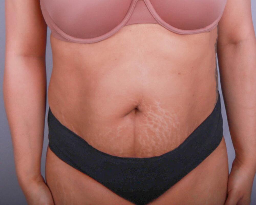 Tummy Tuck Before & After Image