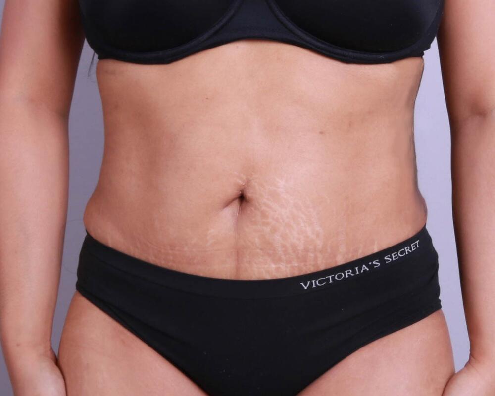 Tummy Tuck Before & After Image