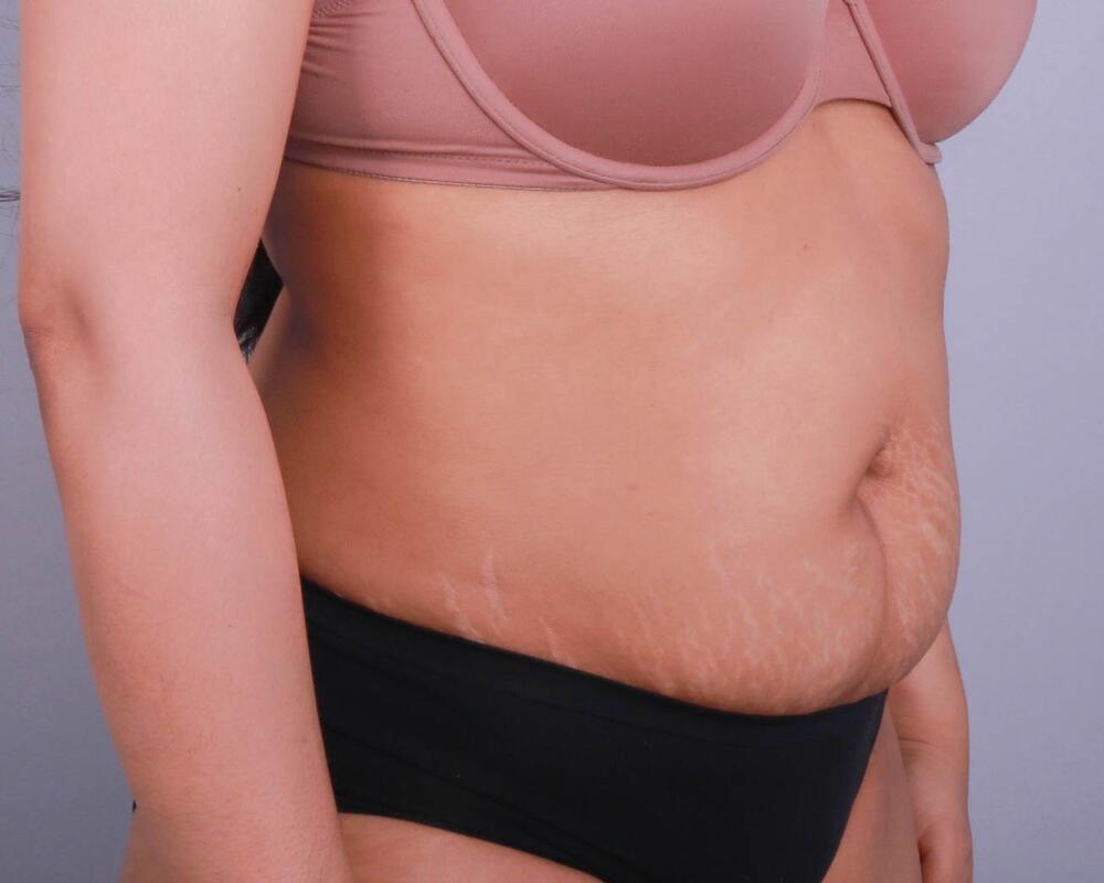 Tummy Tuck Before & After Image