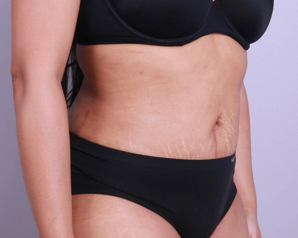 Tummy Tuck Before & After Image