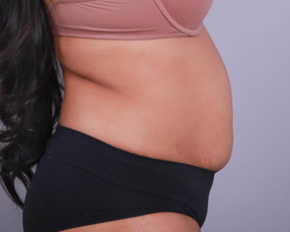 Tummy Tuck Before & After Image