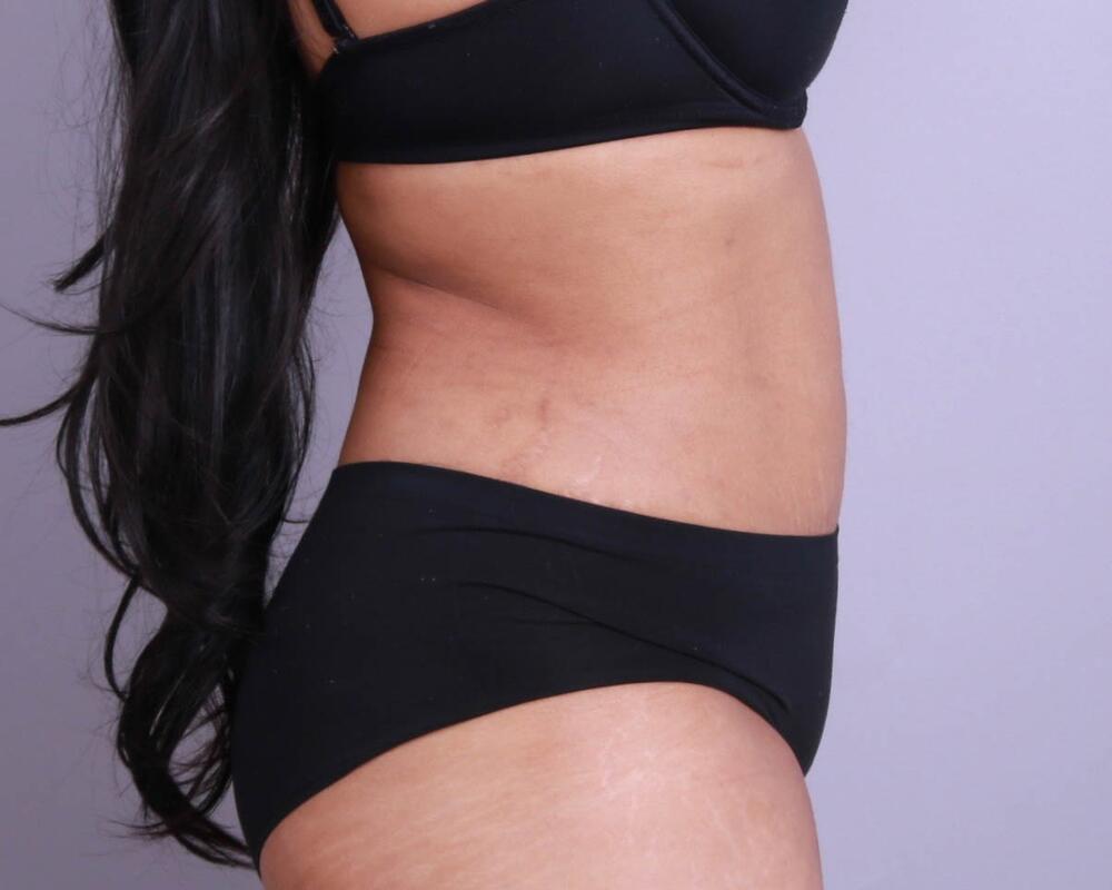 Tummy Tuck Before & After Image