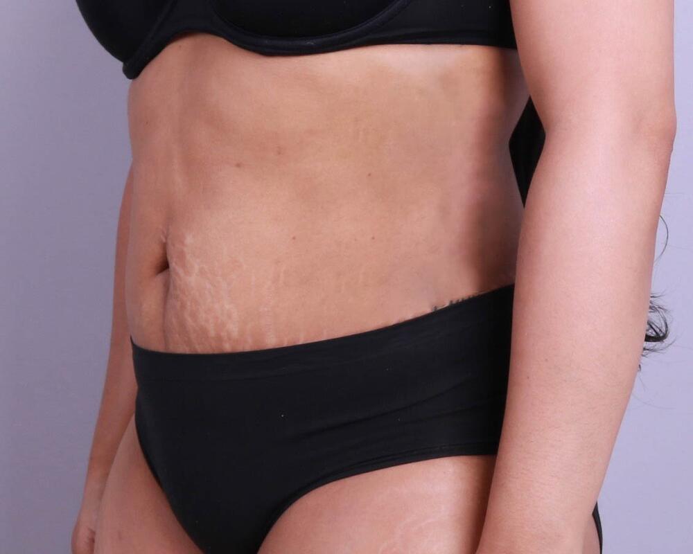 Tummy Tuck Before & After Image