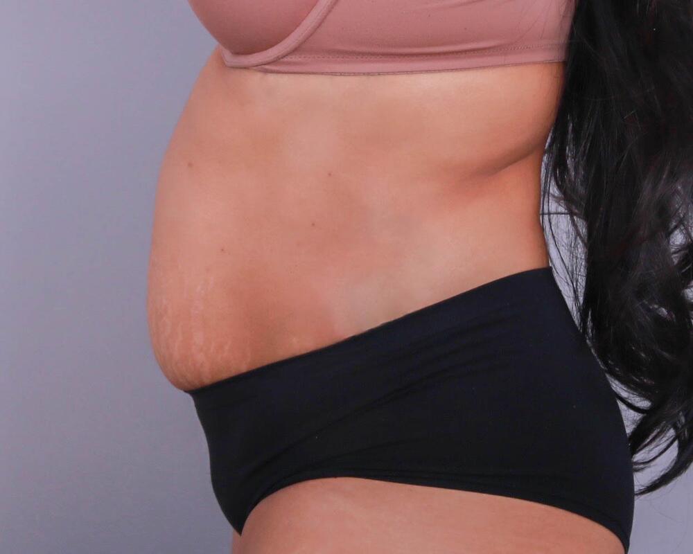 Tummy Tuck Before & After Image