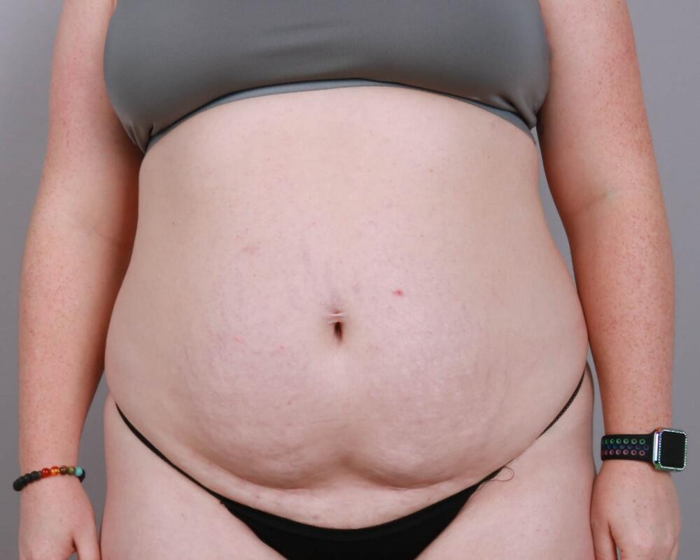 Tummy Tuck Before & After Image