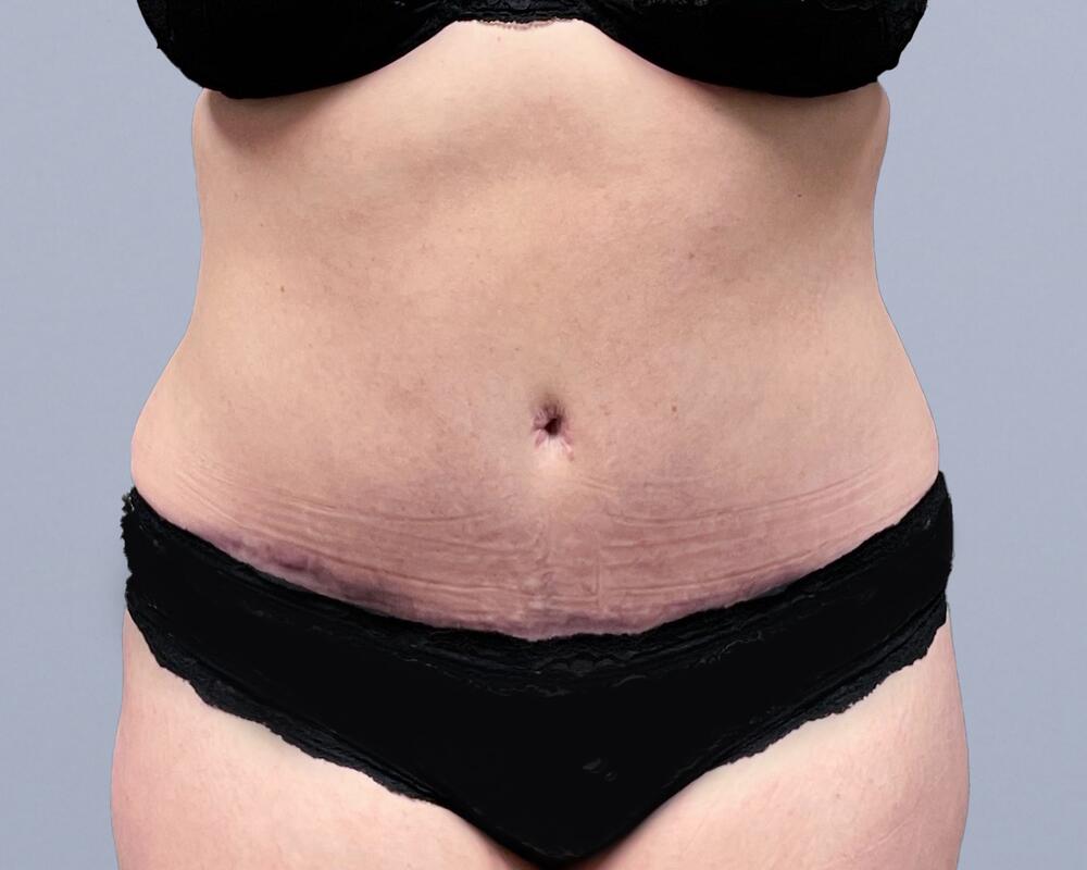 Tummy Tuck Before & After Image