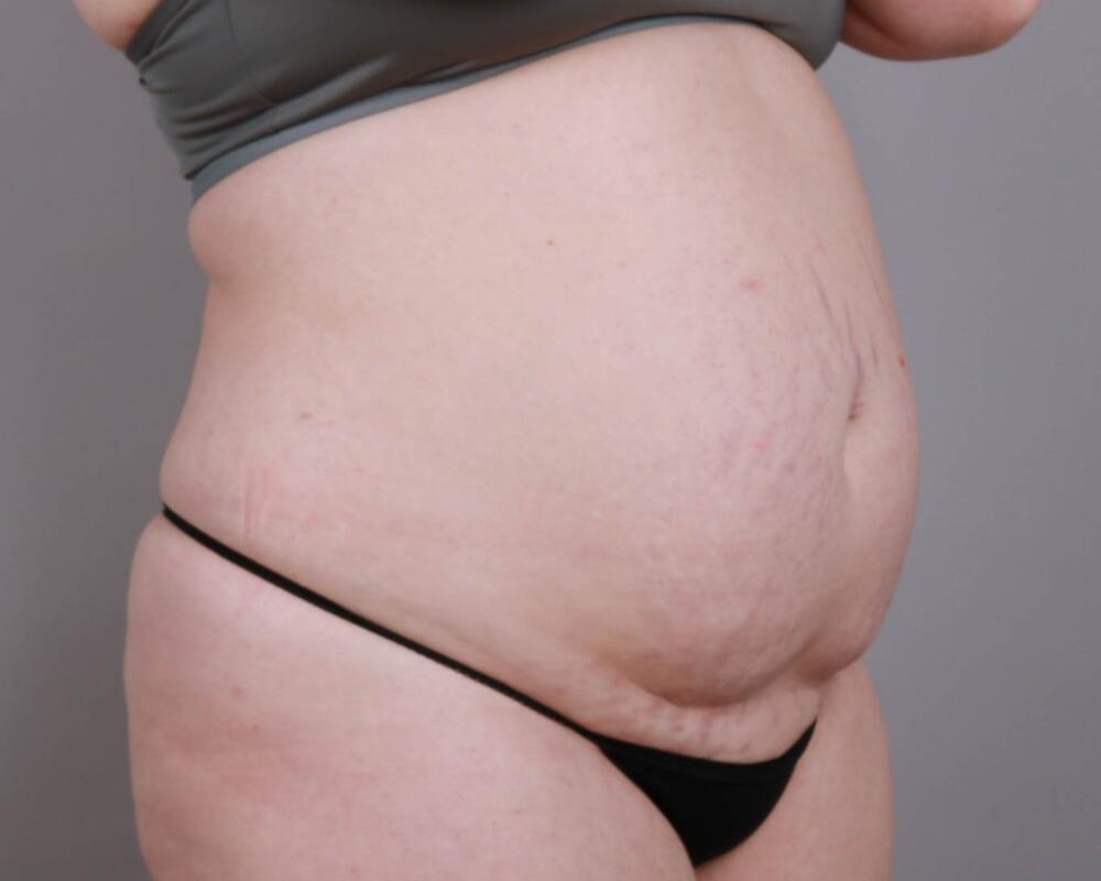 Tummy Tuck Before & After Image