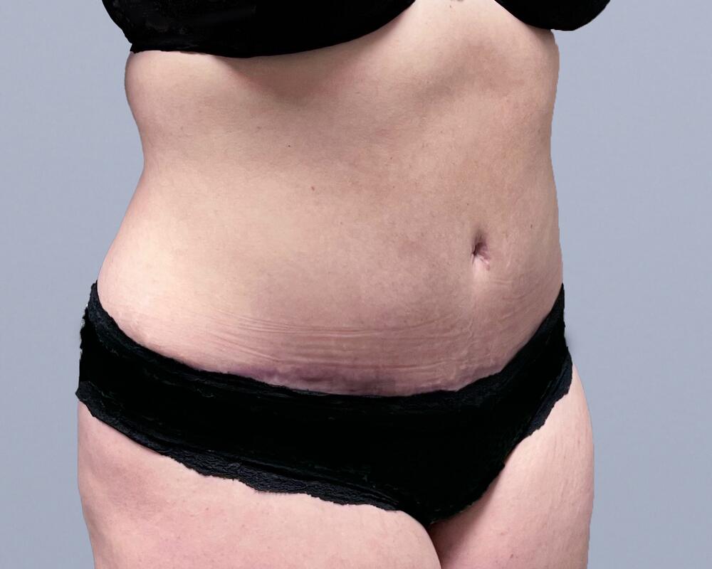 Tummy Tuck Before & After Image