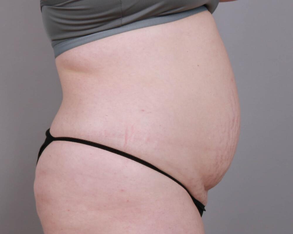 Tummy Tuck Before & After Image