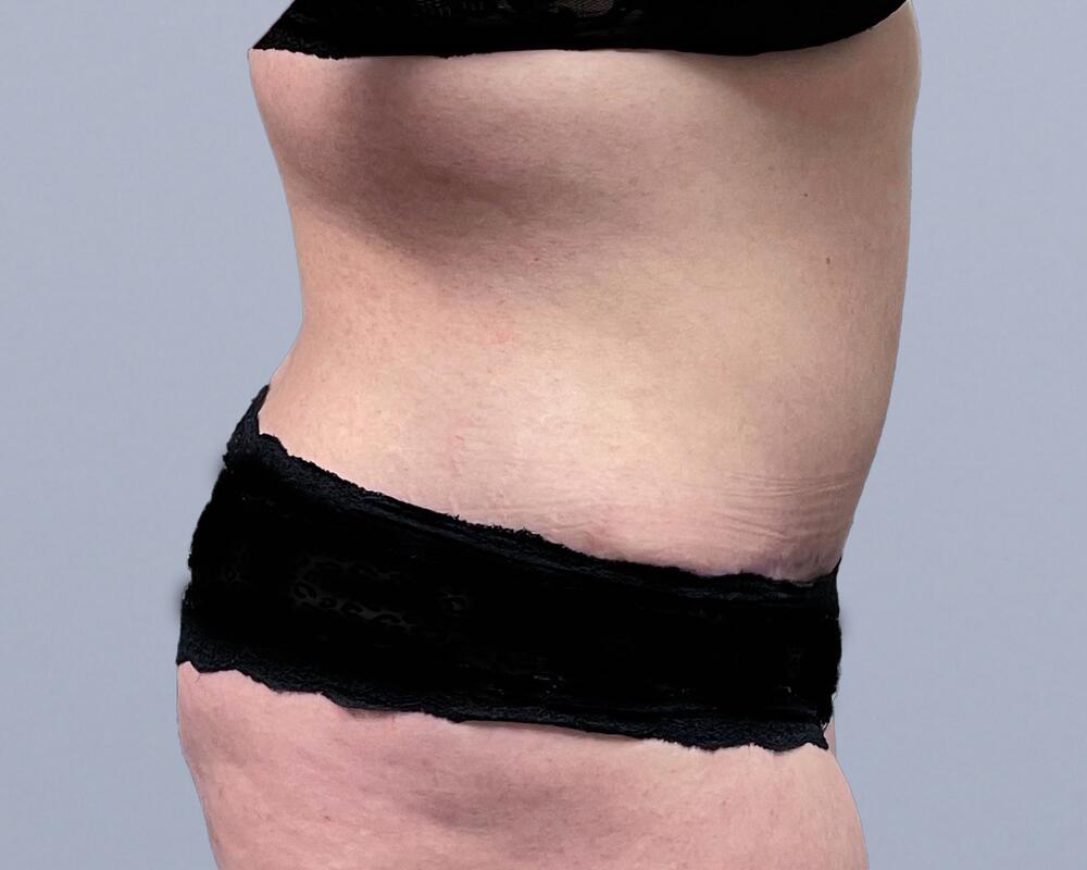 Tummy Tuck Before & After Image