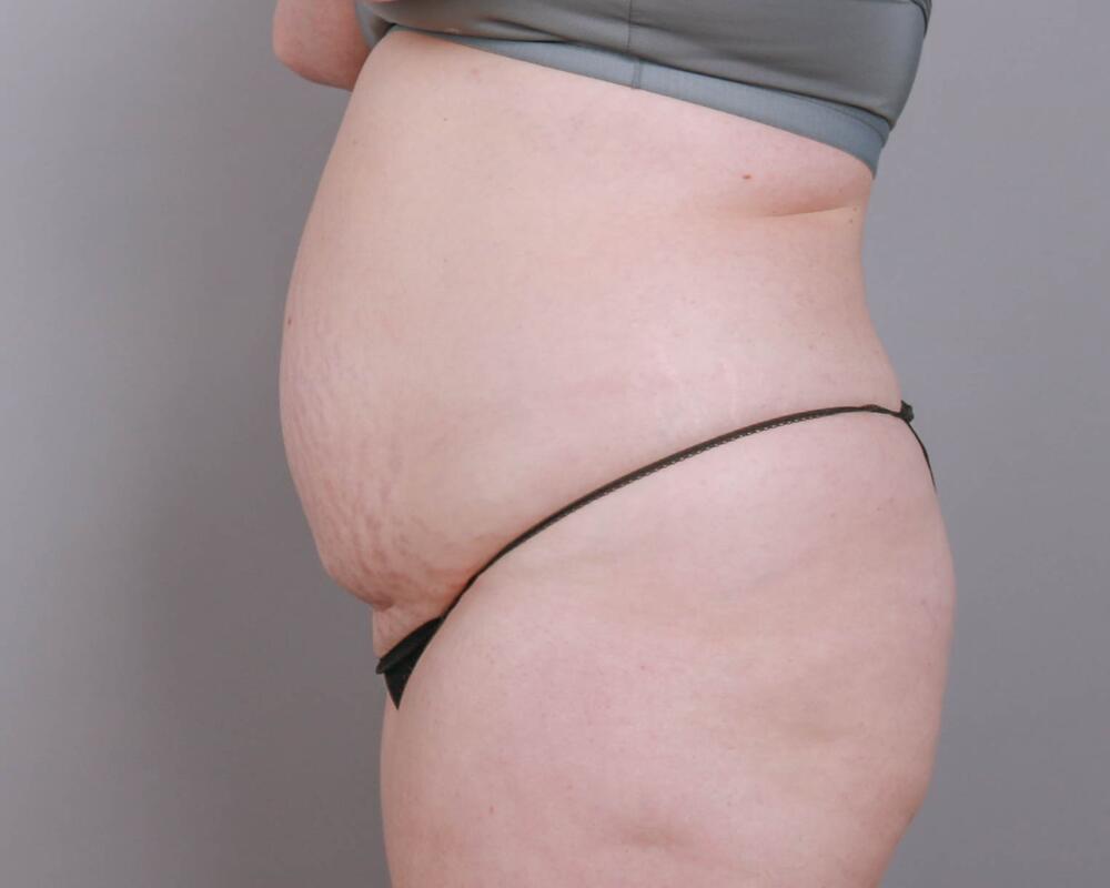 Tummy Tuck Before & After Image