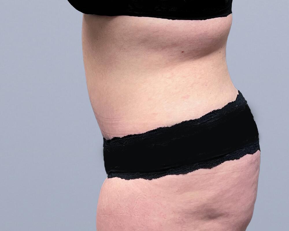 Tummy Tuck Before & After Image