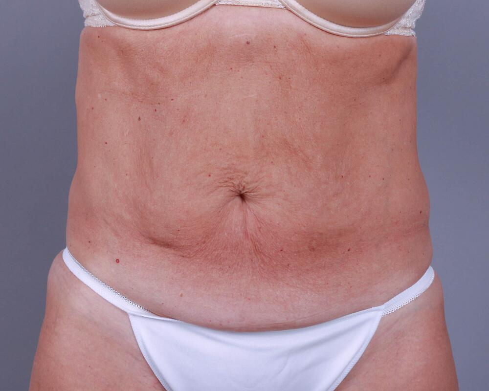 Tummy Tuck Before & After Image