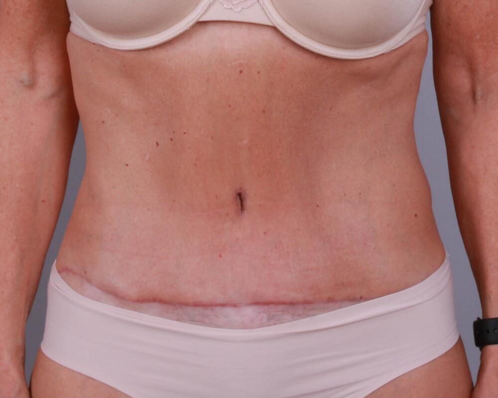 Tummy Tuck Before & After Image