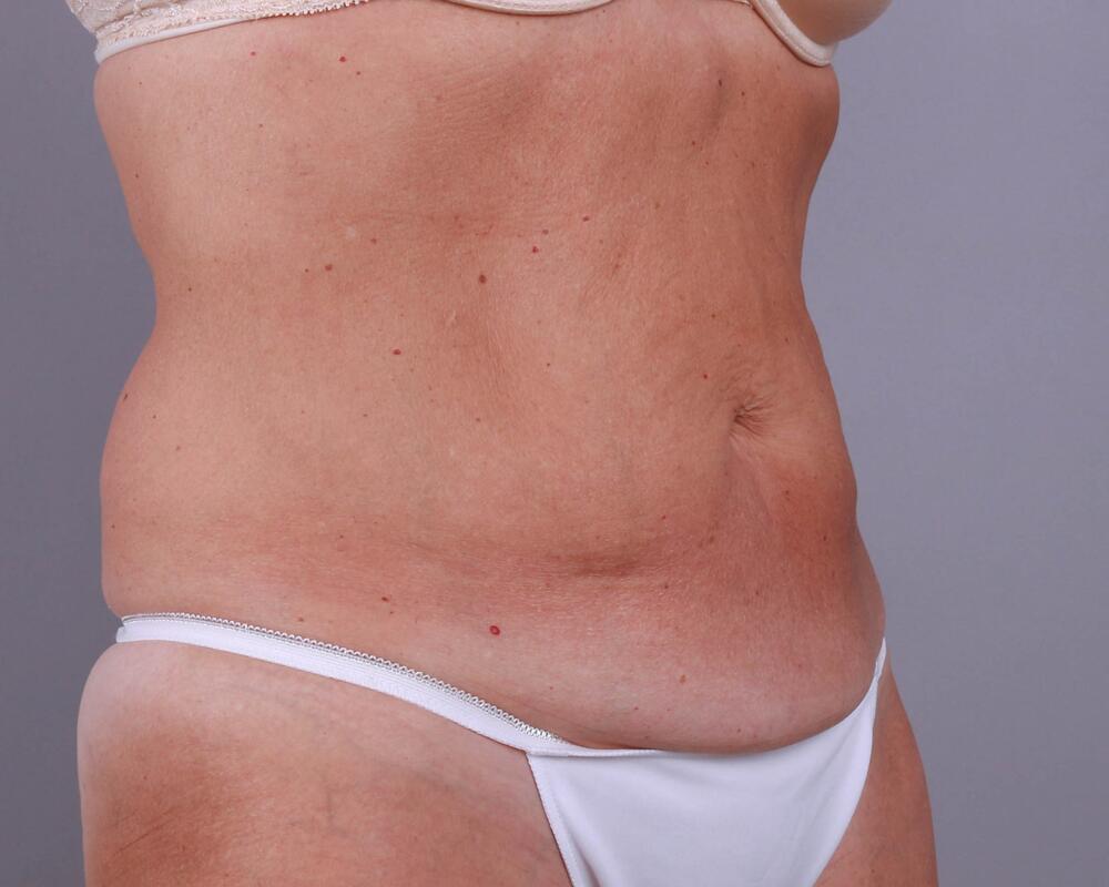 Tummy Tuck Before & After Image