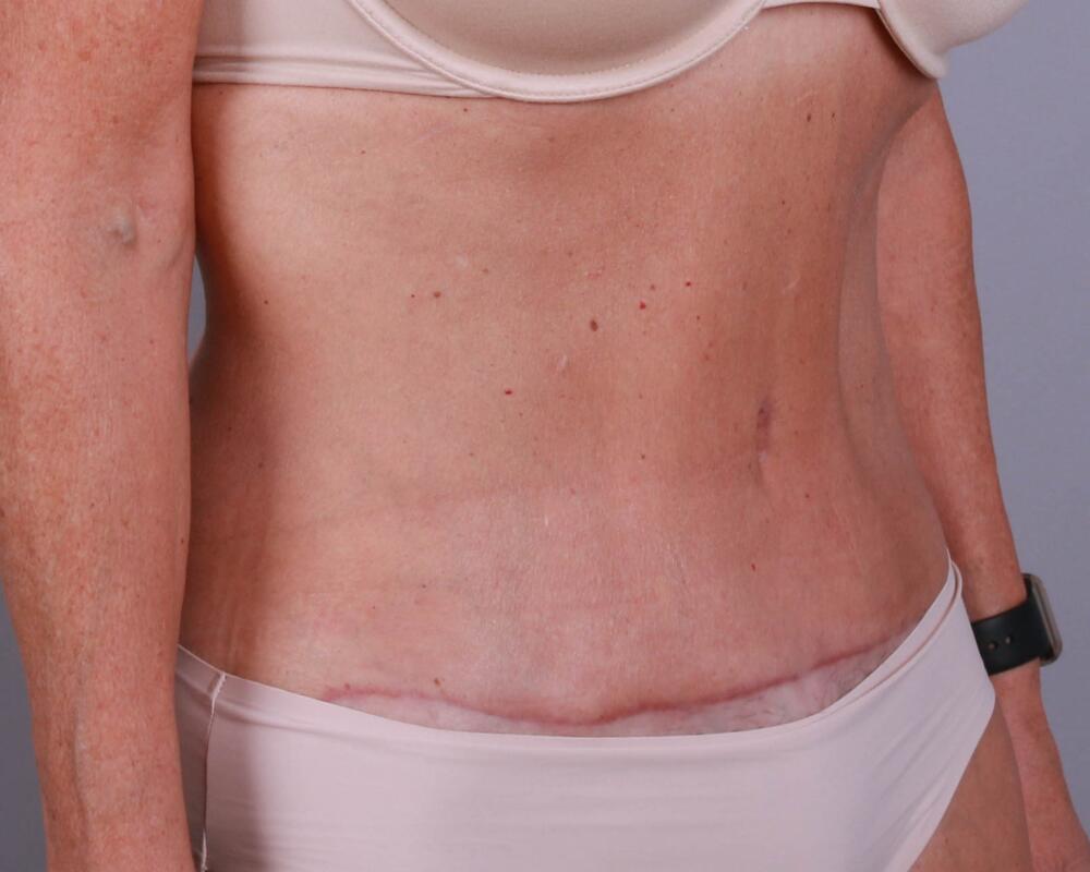 Tummy Tuck Before & After Image