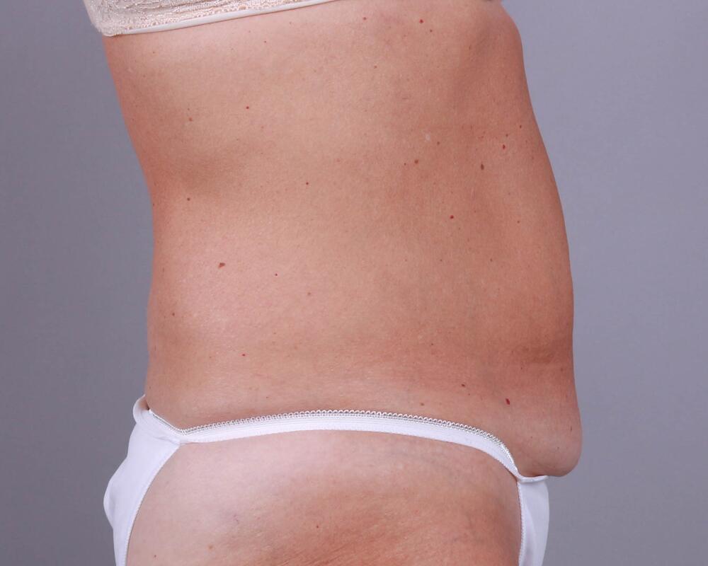 Tummy Tuck Before & After Image