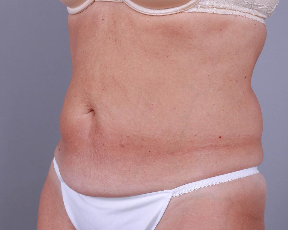 Tummy Tuck Before & After Image