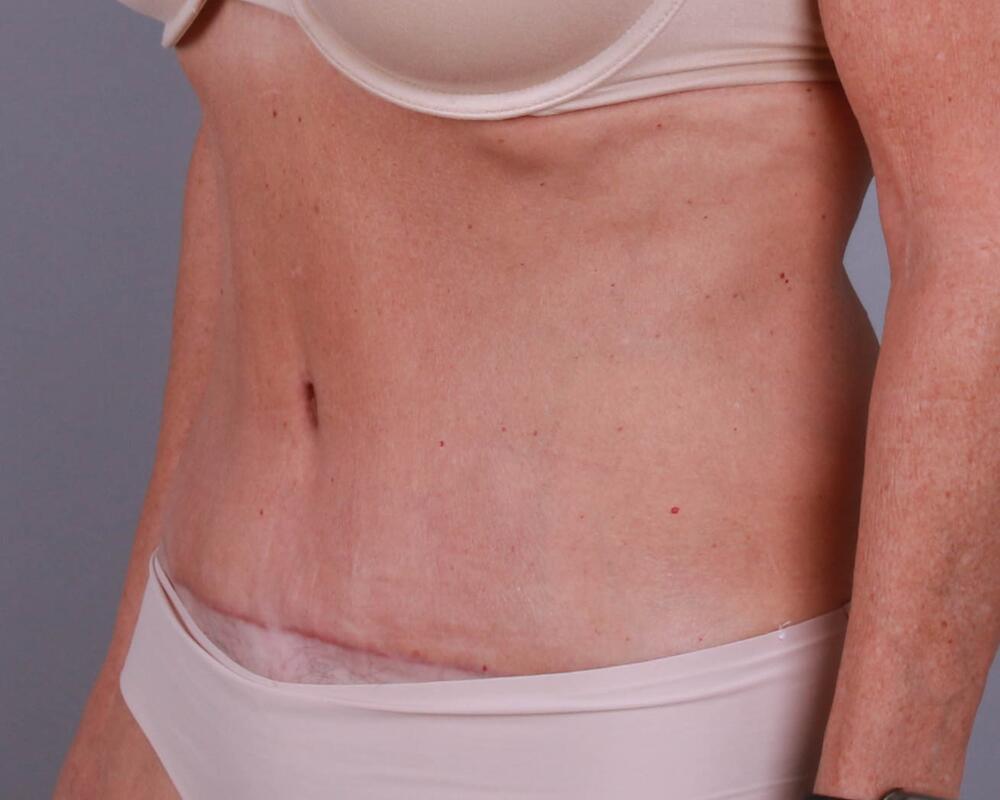 Tummy Tuck Before & After Image