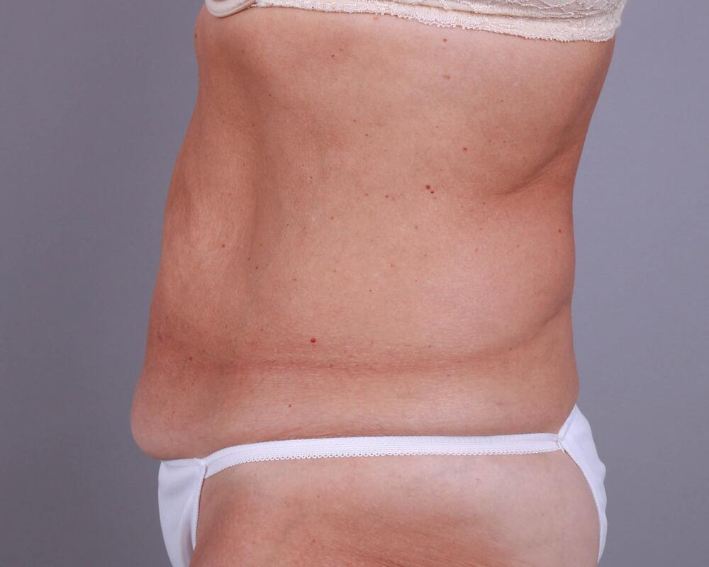 Tummy Tuck Before & After Image