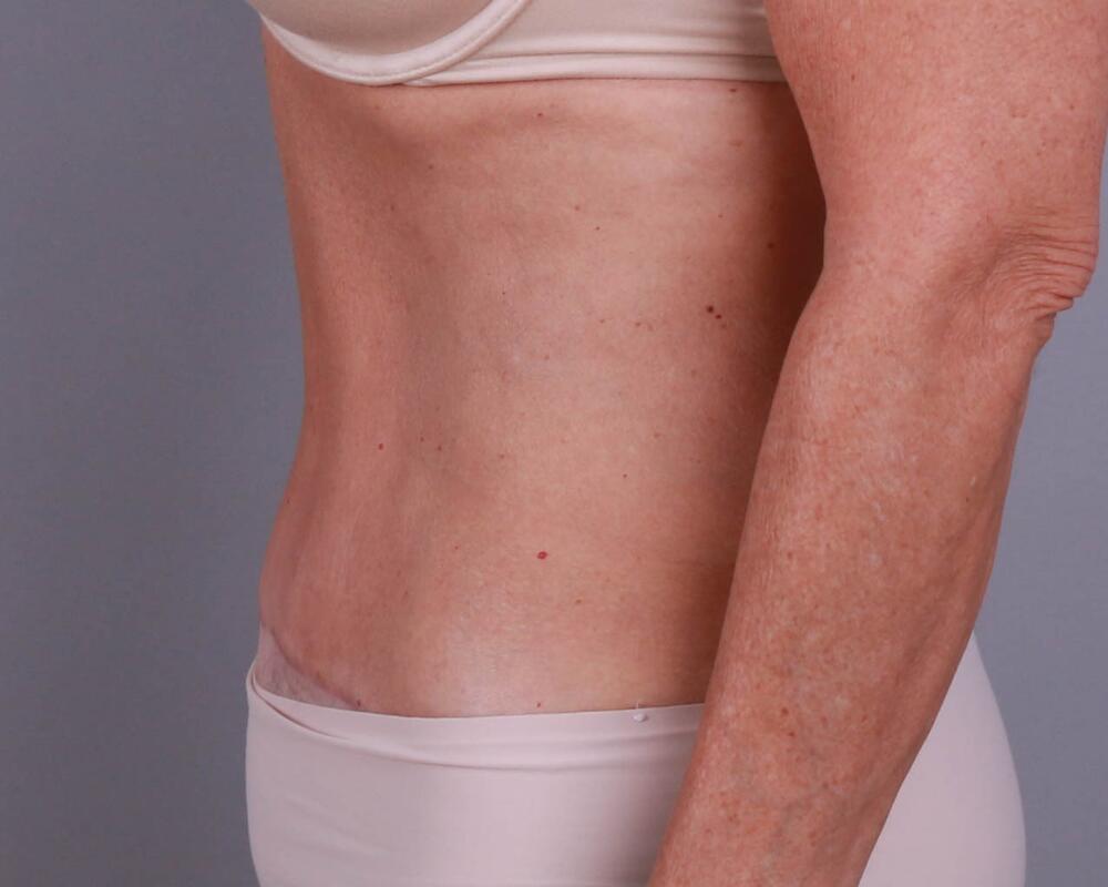 Tummy Tuck Before & After Image