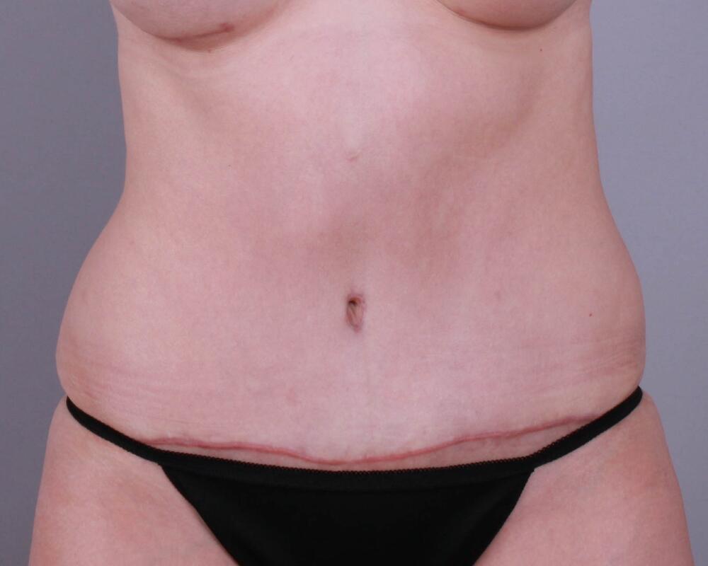 Tummy Tuck Before & After Image